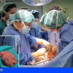 El programa de trasplante hepático de La Candelaria cumple 25 años con casi 800 intervenciones