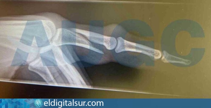 Radiografía que muestra la fractura en el dedo de un guardia civil agredido por un pasajero en el aeropuerto de Lanzarote / AUGC