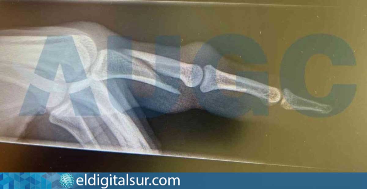 Radiografía que muestra la fractura en el dedo de un guardia civil agredido por un pasajero en el aeropuerto de Lanzarote / AUGC