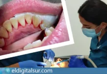 Boca con gingivitis e inflamación de las encías