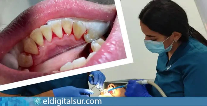Boca con gingivitis e inflamación de las encías