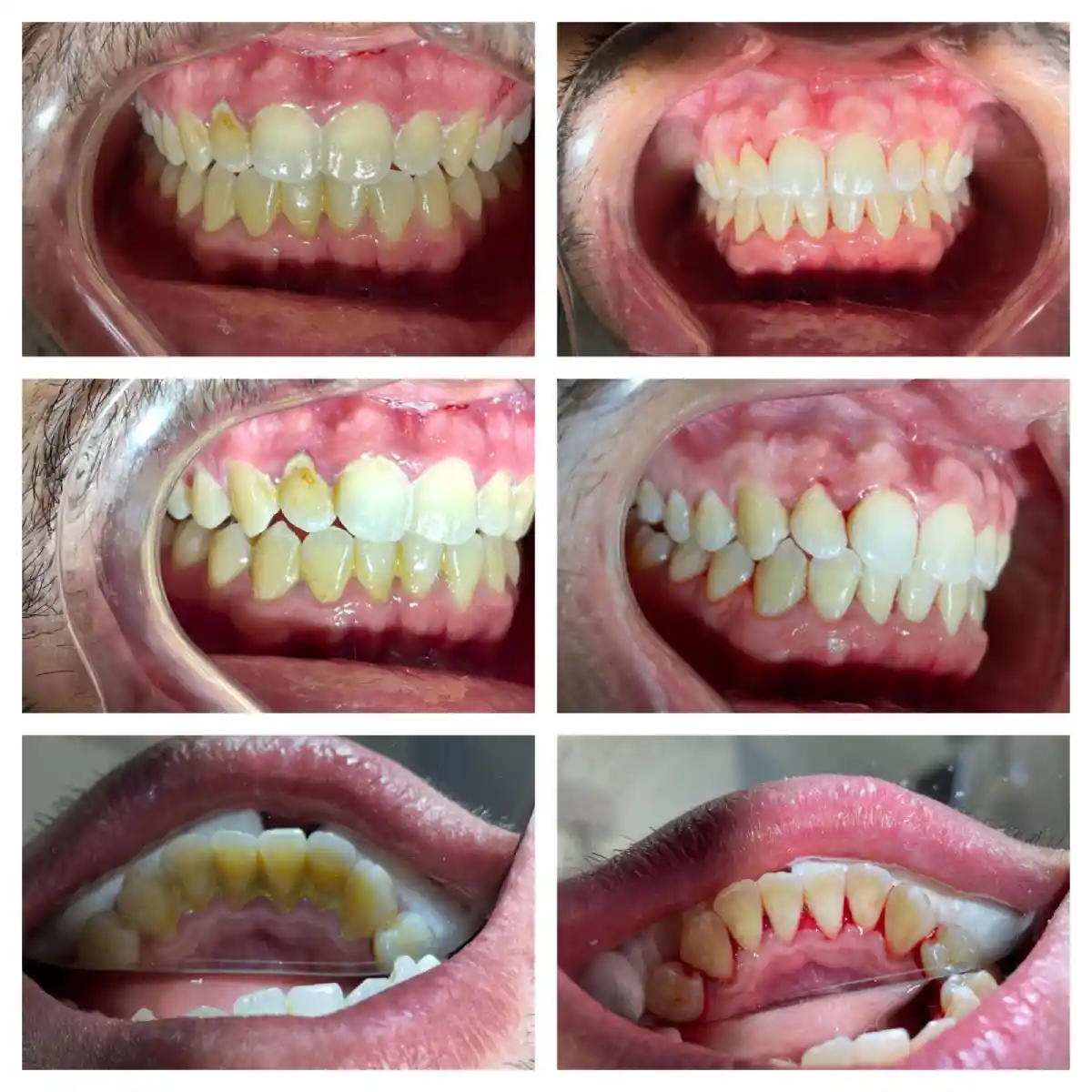 Detalle de la dentición de un paciente con signos de gingivitis